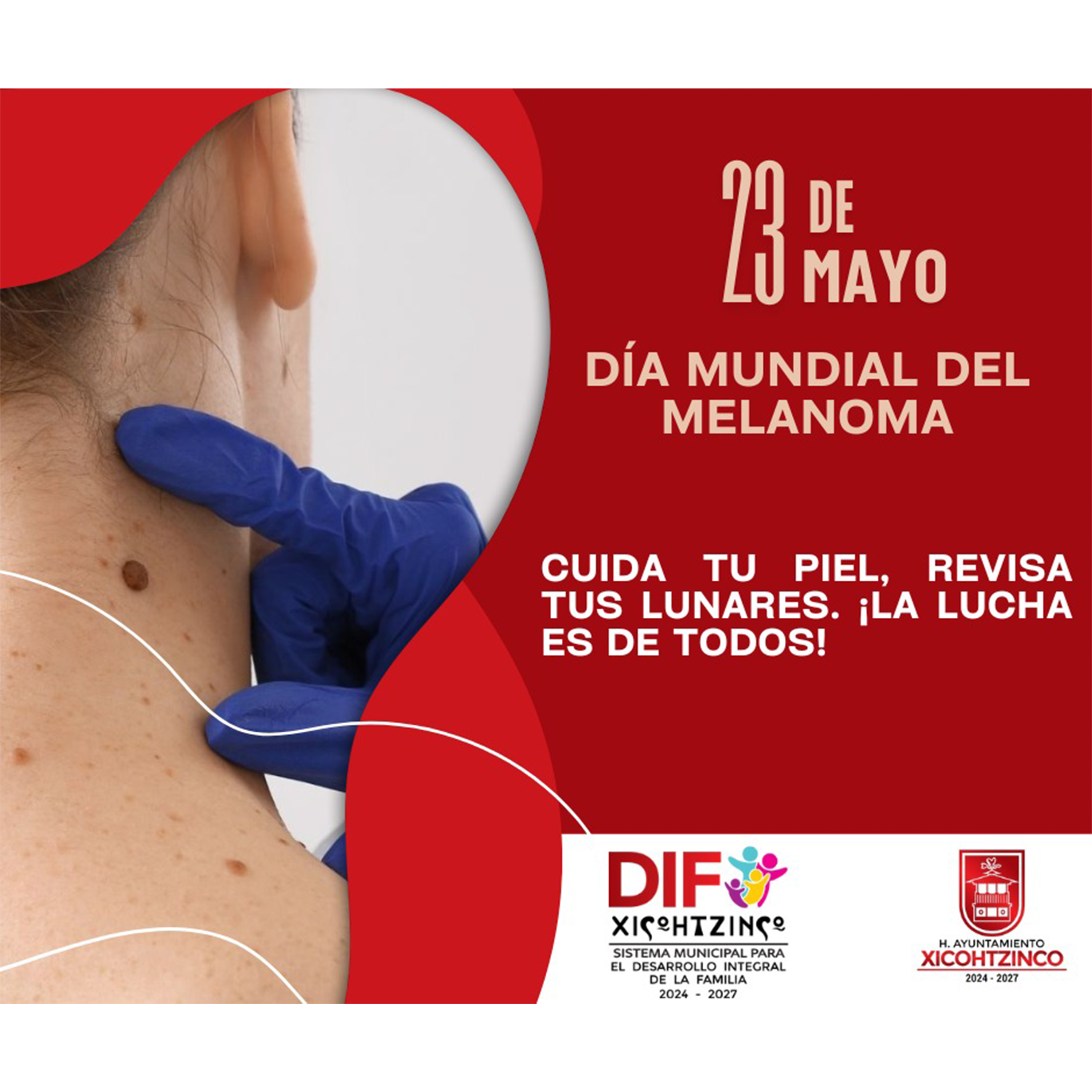 Melanoma